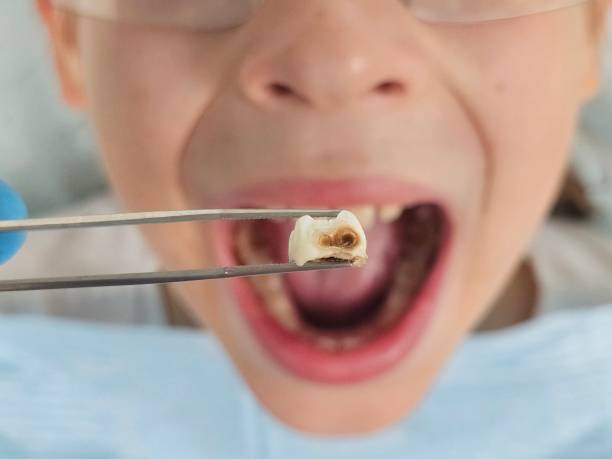Best Emergency Dental Extractions in Channel Lake, IL